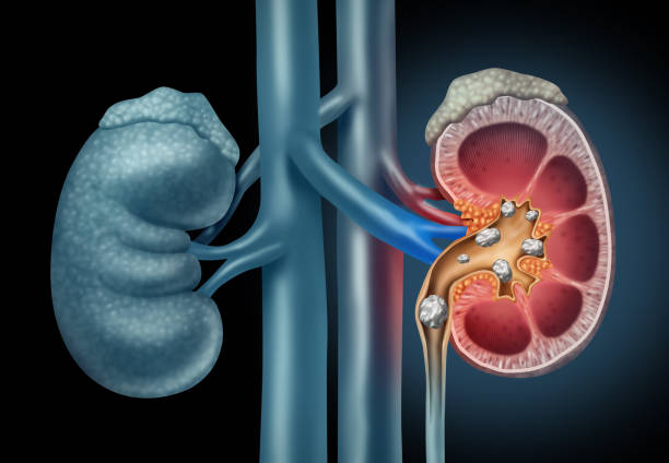 DIY Kidney Care: Simple Steps to Preventing Kidney Stones at Home